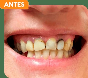 Antes do tratamento