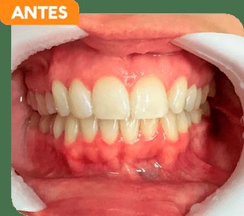 Antes do clareamento